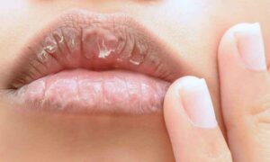 Symptoms of Dry Lips